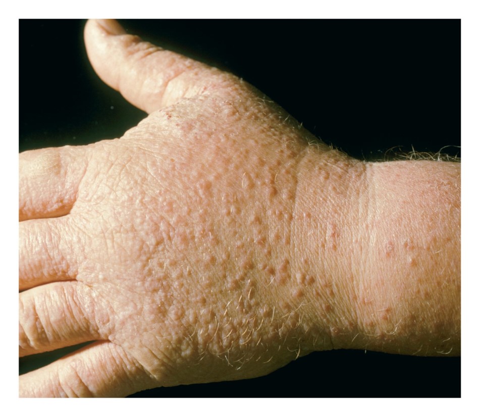 Contact dermatitis