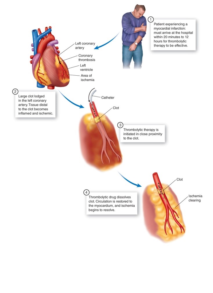 The early diagnosis and treatment of myocardial infarction (MI)