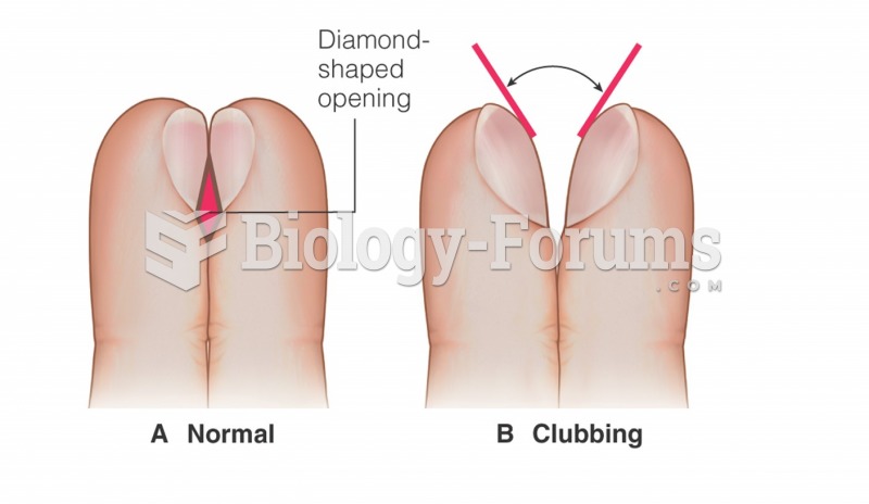 Schamroth test  A.  Healthy nail  B.  Clubbing