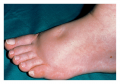 Pitting edema of the lower extremities