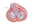 Mitral stenosis