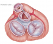 Pulmonic stenosis