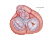 Tricuspid stenosis