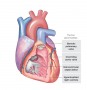 Tetralogy of Fallot