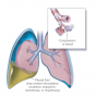 Pleural effusion