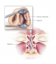 Deviated septum