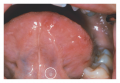 Aphthous ulcers