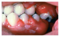 Gingival hyperplasia