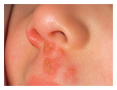 Herpes simplex