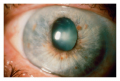 Acute glaucoma