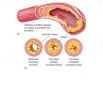 Plaque and thrombus formation in the coronary artery