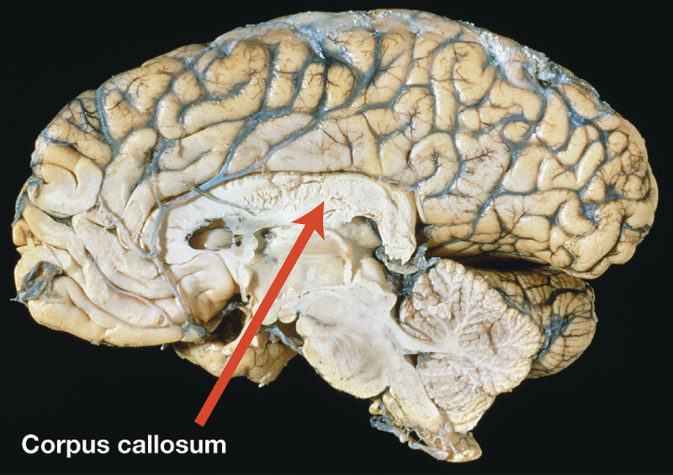 Corpus Callosum