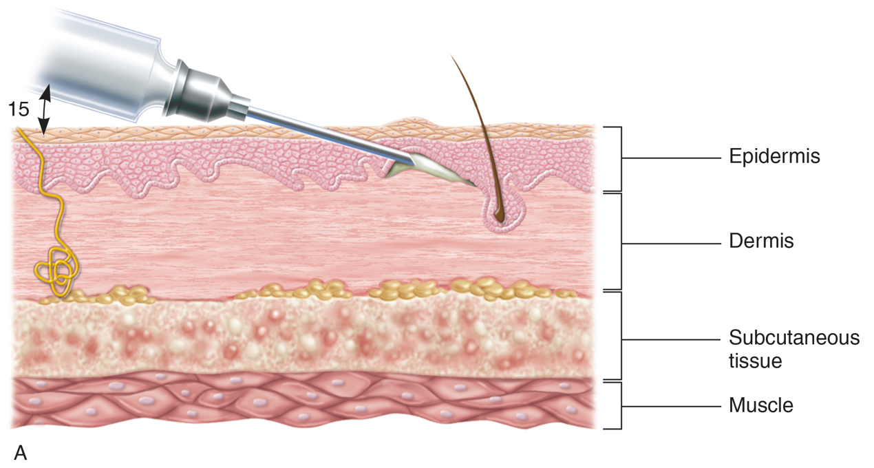 Angles and Depths of Injection for Intradermal