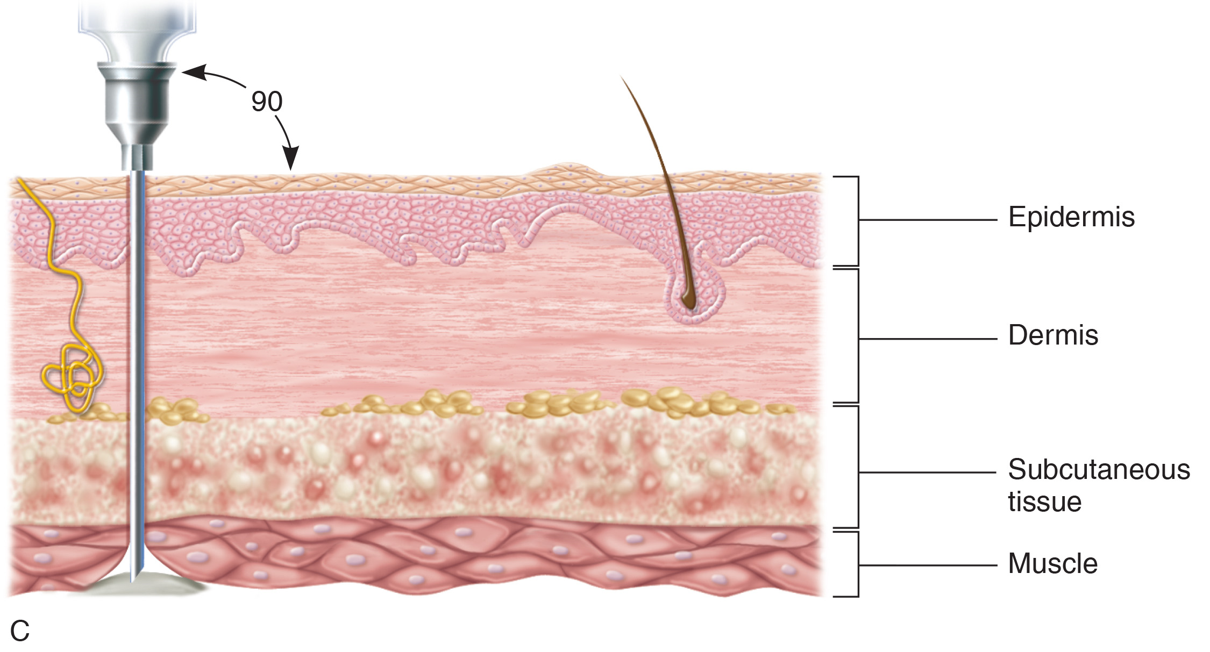 Intramuscular