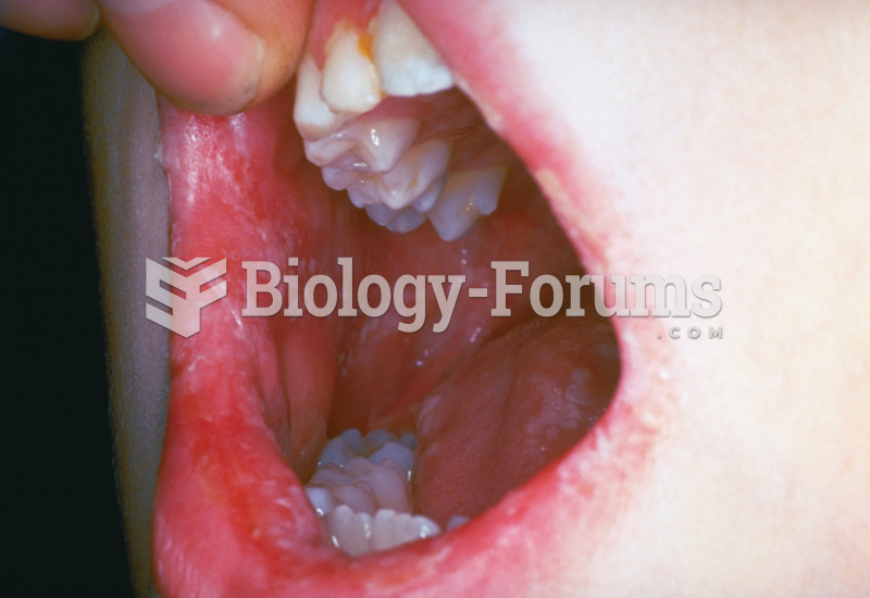 Oral Candida Albicans