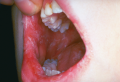 Oral Candida Albicans