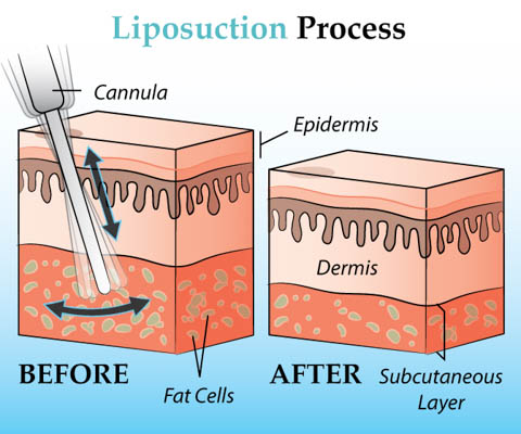 How liposuction works?