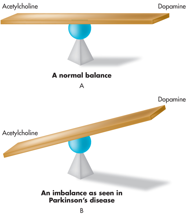 Normal (A) and Abnormal (B) Balance between Dopamine and Acetylcholine