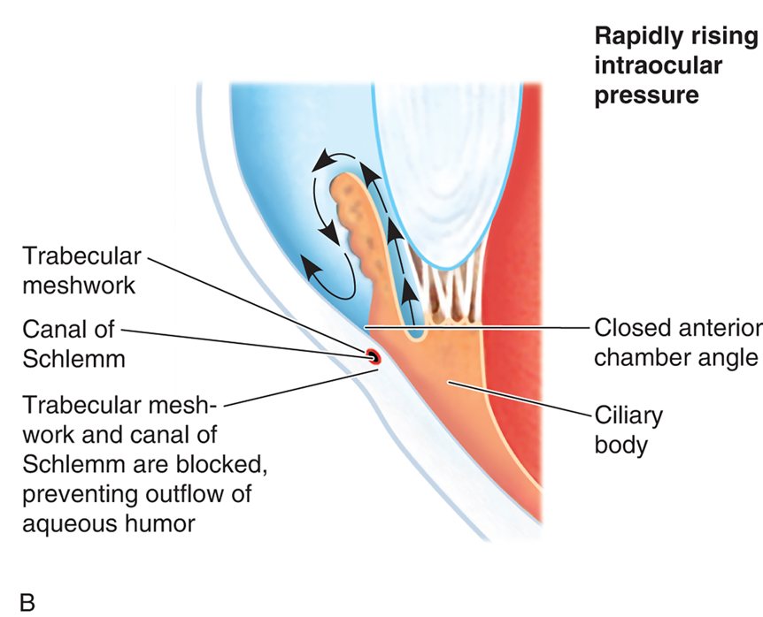 The Pathophysiology of Glaucoma (B) Rapidly Rising I O P