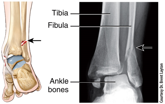 Fracture and Repair of Bone - Pott