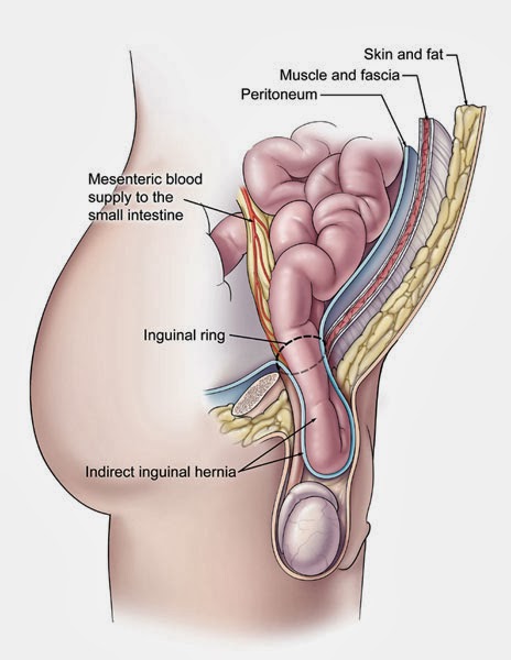 Inguinal (groin) hernia