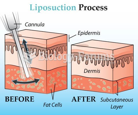 How liposuction works?