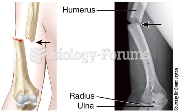 Fracture and Repair of Bone Open (Compound)