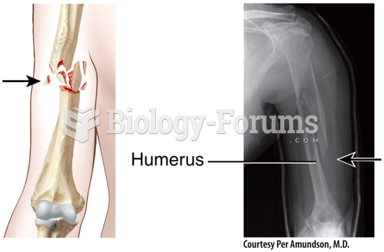 Fracture and Repair of Bone - Comminuted