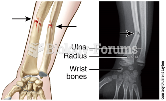Fracture and Repair of Bone - Greenstick
