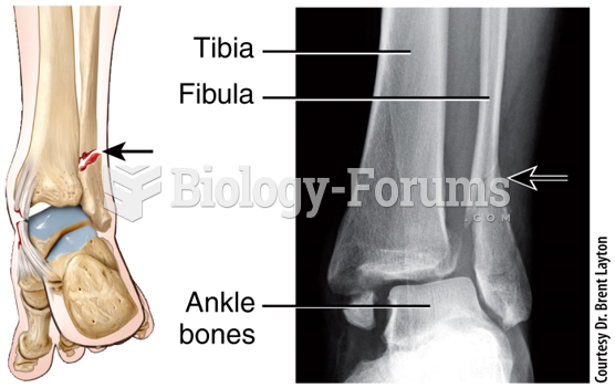 Fracture and Repair of Bone - Pott