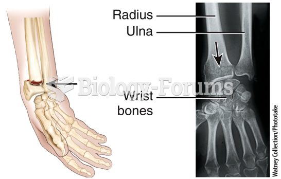 Fracture and Repair of Bone - Colles