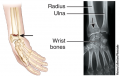 Fracture and Repair of Bone - Colles