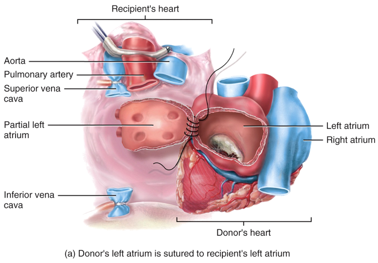 Help for Failing Hearts