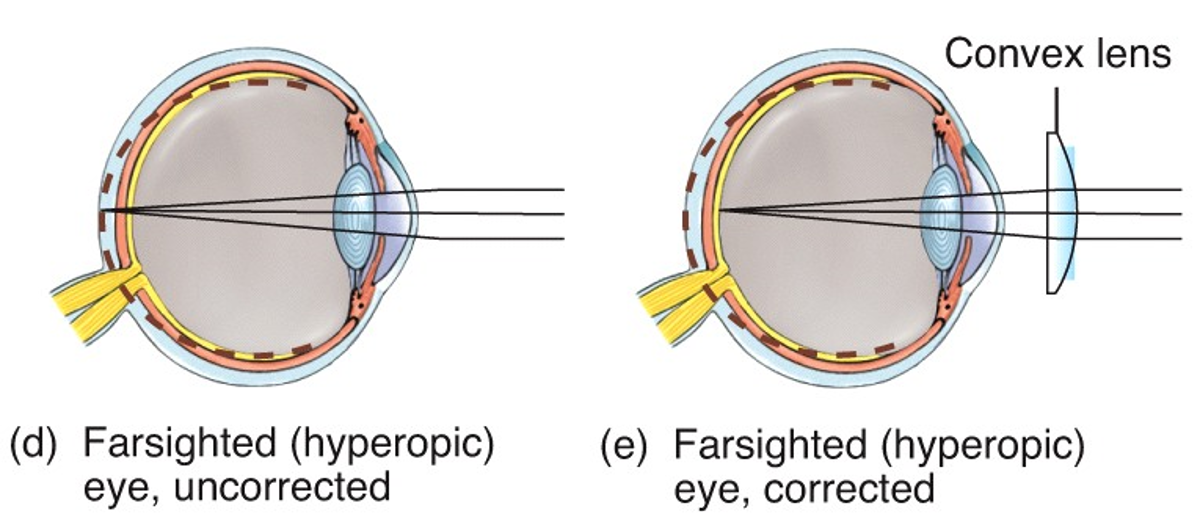 Hyperopia (farsightedness)