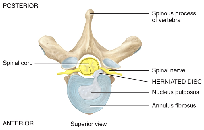 Herniated disc