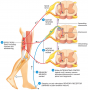 Flexor (Withdrawal) Reflex