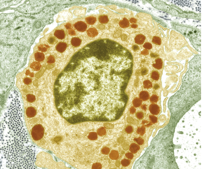 A Gaucher cell showing accumulated fat stored in structures called lysosomes