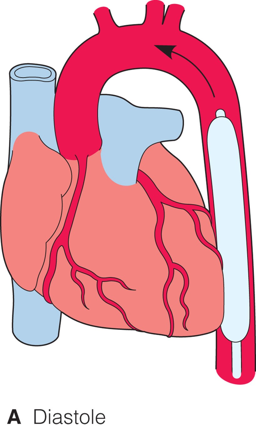 Intraaortic balloon pump. When inflated during diastole, the balloon supports cerebral, renal, and c