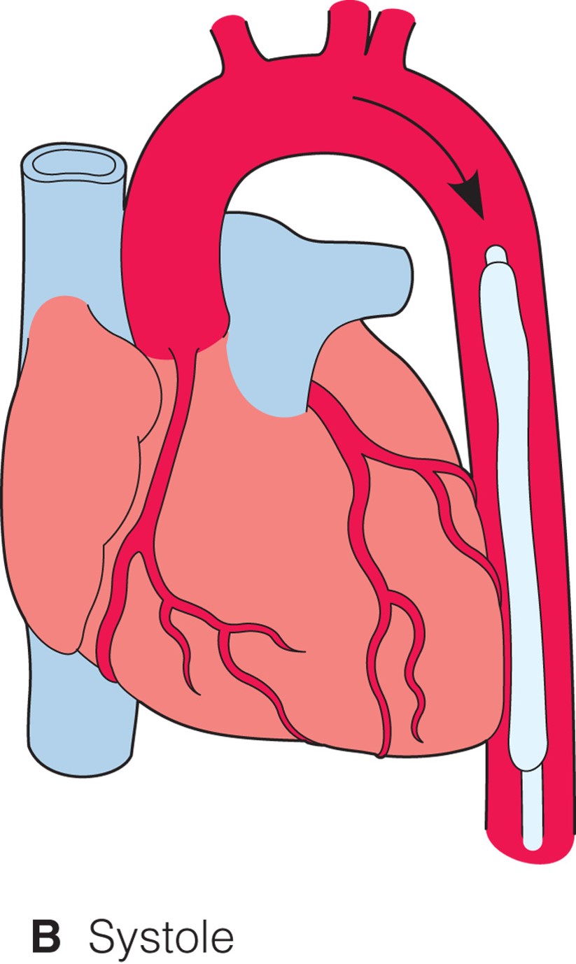 Intraaortic balloon pump. The balloon deflates during systole, so cardiac output is unimpeded.