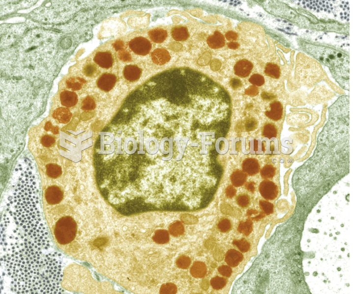 A Gaucher cell showing accumulated fat stored in structures called lysosomes