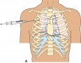 Needle thoracostomy