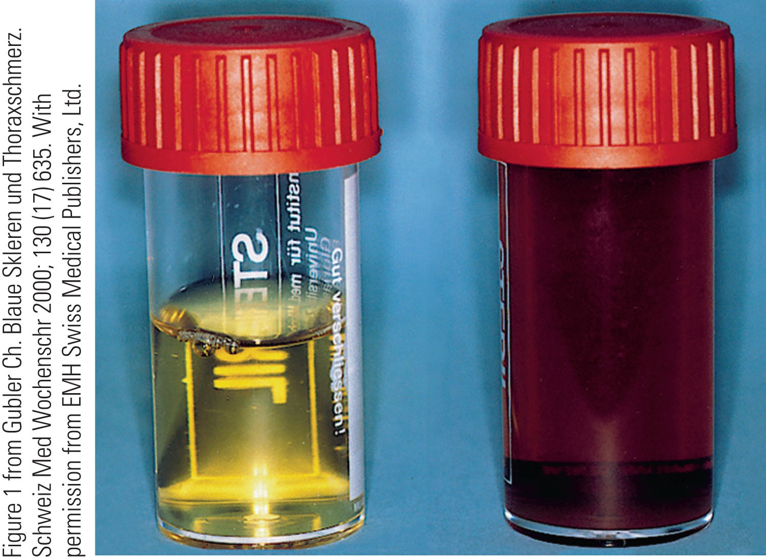 (left) Urine sample from an unaffected person does not change color upon exposure to air. (right) Ur