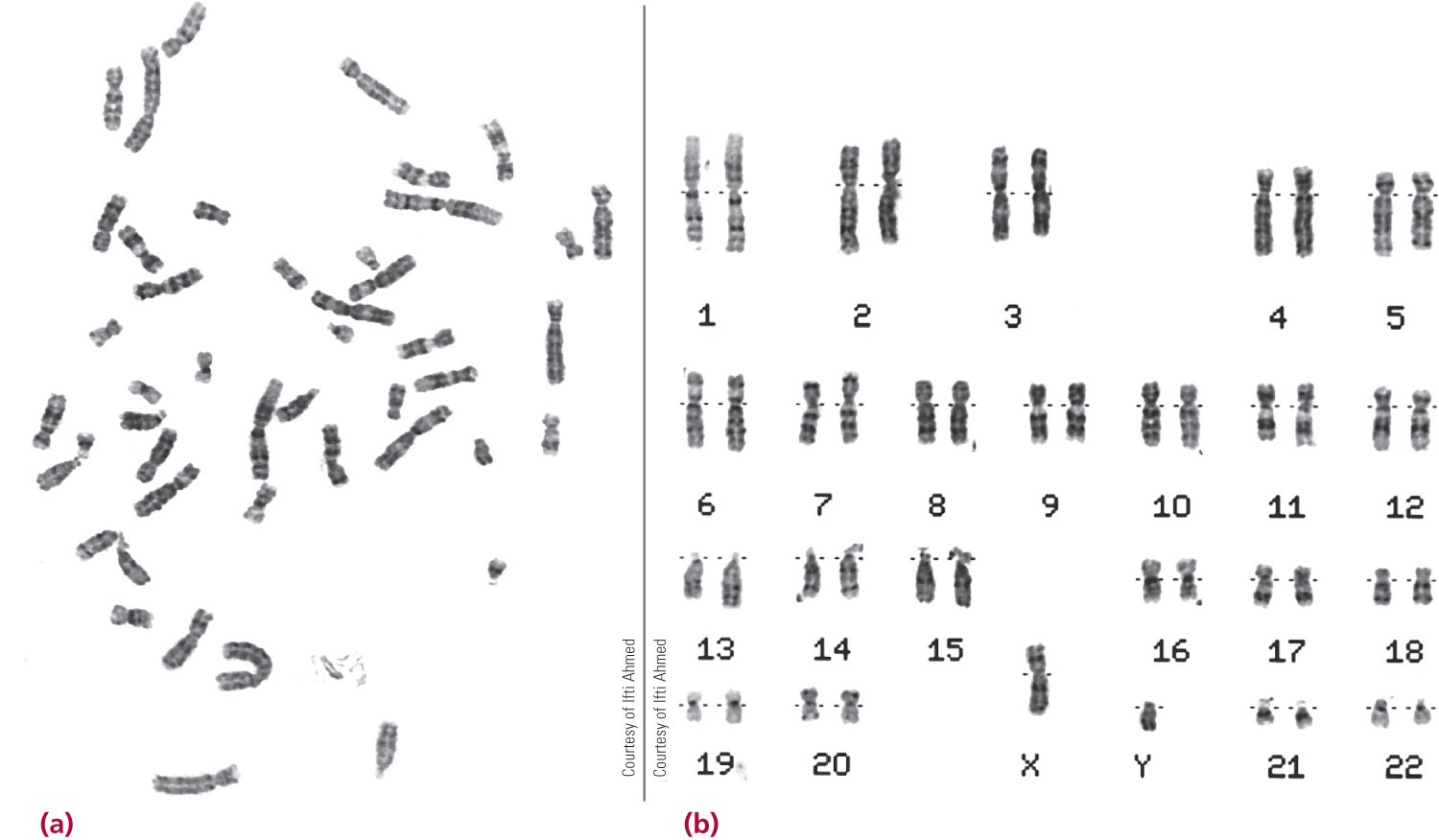 (a) A metaphase array of chromosomes as viewed in the microscope. (b) The computer-derived karyotype