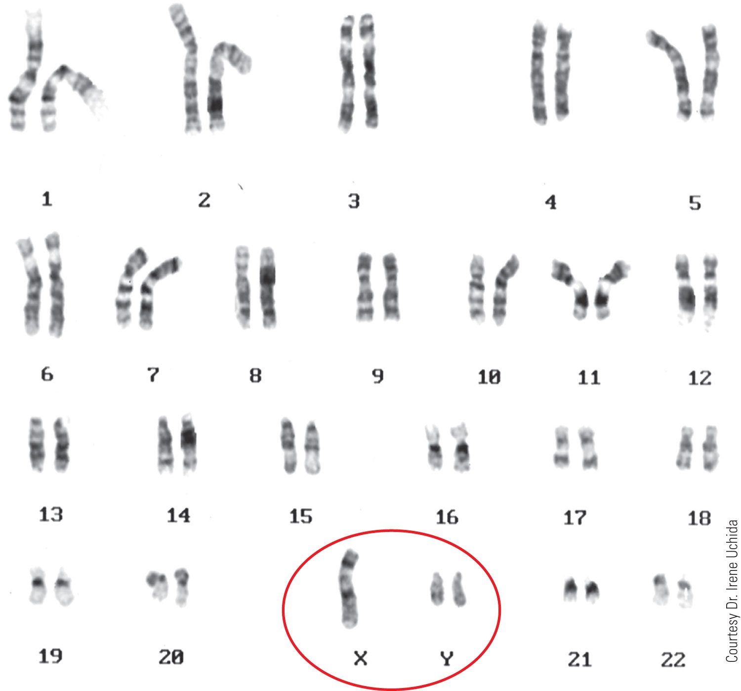 The karyotype of an XYY male. Affected individuals are usually taller than normal, and some, but not