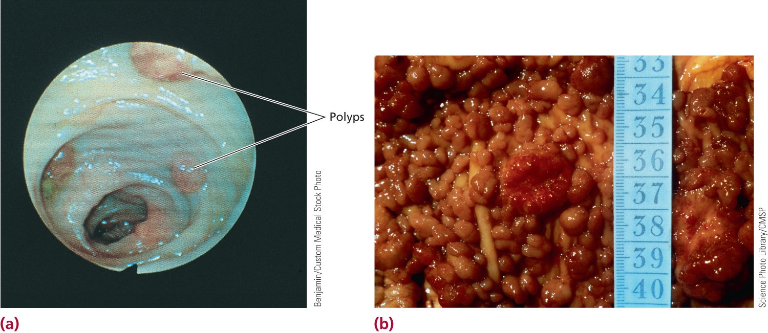 An endoscopic view of the colon of someone who carries the normal alleles for the APC gene