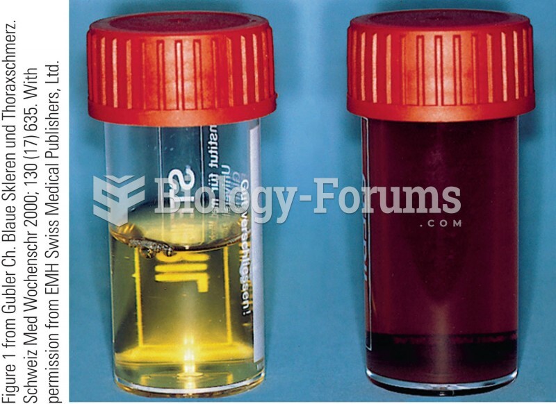 (left) Urine sample from an unaffected person does not change color upon exposure to air. (right) Ur