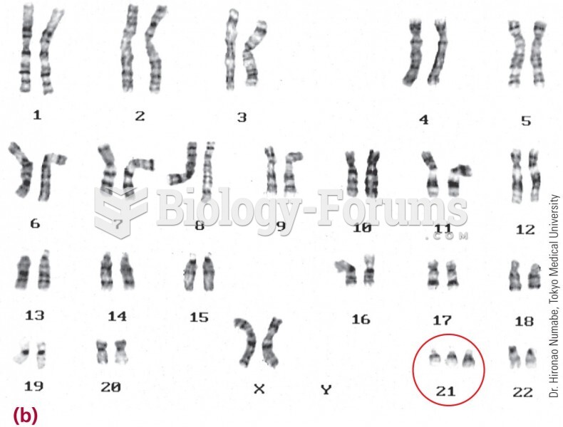 A karyotype shows this child has three copies of chromosome 21.