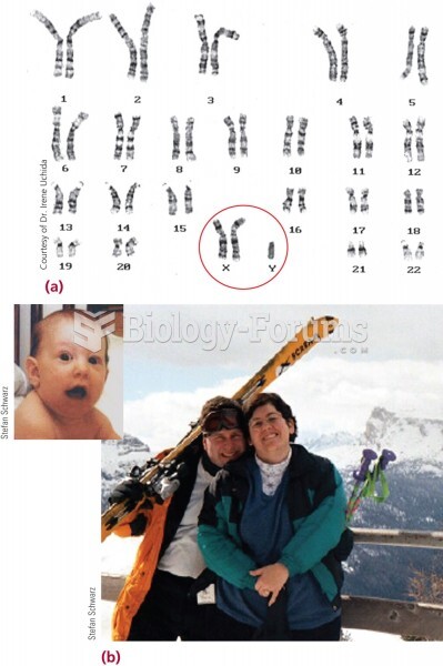 (a) The characteristic karyotype of Klinefelter syndrome. (b) The young man (left) in these photos h