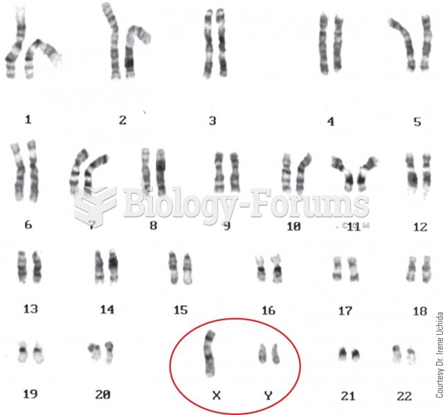 The karyotype of an XYY male. Affected individuals are usually taller than normal, and some, but not