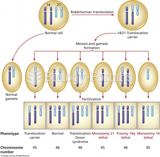 Segregation of chromosomes at meiosis in a 14/21 translocation carrier. Six types of gametes are pro
